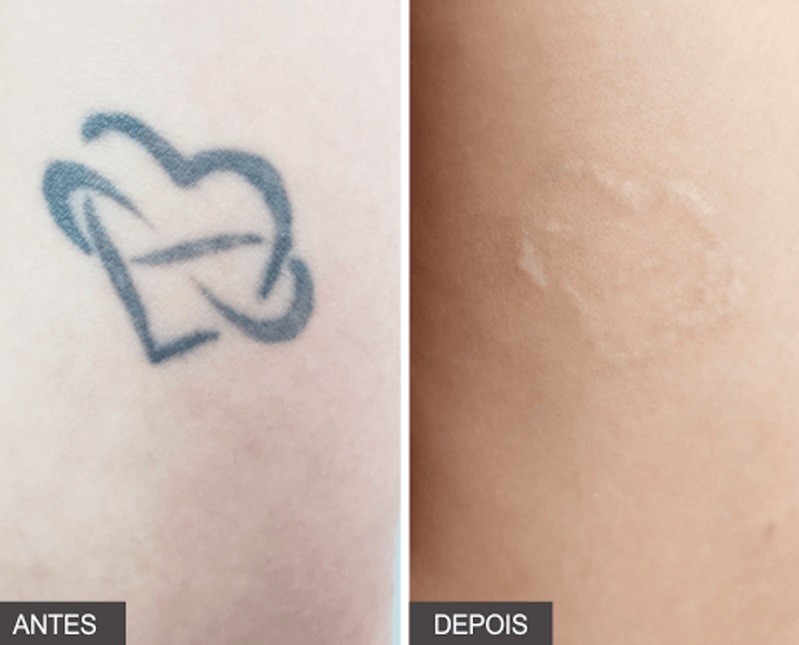 Remoção Tatuagem