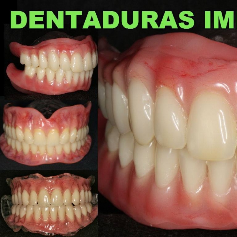 Prótese Dentária (Frente Força)